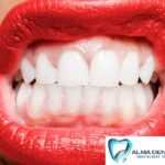 INCLUYE ✓ DESTRATRAJE SUPRGINGIVAL CON Ultrasonido. ✓ PULIDO CORONARIO - 13